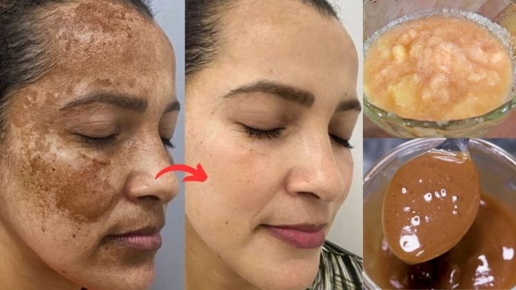 Permanent Skin Bleaching Oil In Sulima Town in Sierra Leone, Skin Whitening Products In Whitesburg Town in Georgia, United States Call ☏ +27710732372 Scars And Stretch Marks Removal Cream In Rustenburg, Pimple Treatment In Louis Trichardt South Africa