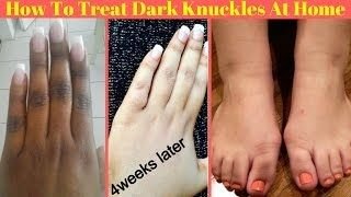 Permanent Skin Bleaching Oil In Sulima Town in Sierra Leone, Skin Whitening Products In Whitesburg Town in Georgia, United States Call ☏ +27710732372 Scars And Stretch Marks Removal Cream In Rustenburg, Pimple Treatment In Louis Trichardt South Africa