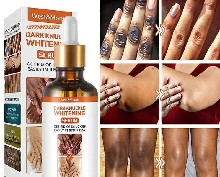 Dark Knuckle Whitening Serum In Mano Town in Sierra Leone, Elbow And Knee Brightening Serum In Roopville Town in Georgia Call ☏ +2771 073 2372 Get Rid Of Vitiligo In Vaasa City In Finland, Scars And Stretch Marks In Vereeniging City In South Africa