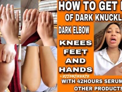 Dark Knuckle Whitening Serum In Mano Town in Sierra Leone, Elbow And Knee Brightening Serum In Roopville Town in Georgia Call ☏ +2771 073 2372 Get Rid Of Vitiligo In Vaasa City In Finland, Scars And Stretch Marks In Vereeniging City In South Africa