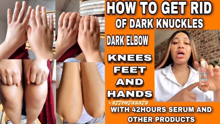 Dark Knuckle Whitening Serum In Mano Town in Sierra Leone, Elbow And Knee Brightening Serum In Roopville Town in Georgia Call ☏ +2771 073 2372 Get Rid Of Vitiligo In Vaasa City In Finland, Scars And Stretch Marks In Vereeniging City In South Africa